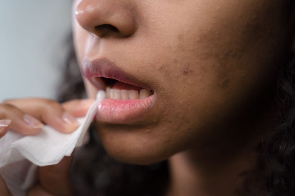 Is Azelaic Acid Good for Hormonal Acne?